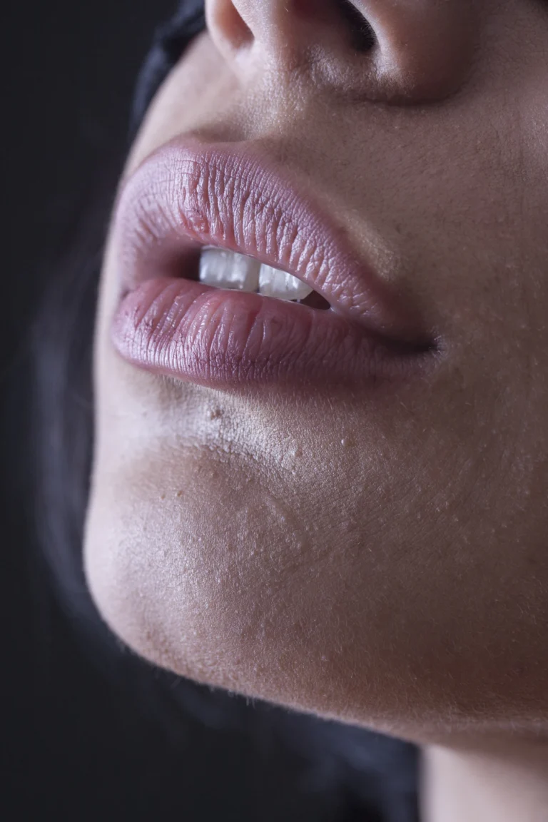 Defined lip border after lip shaping