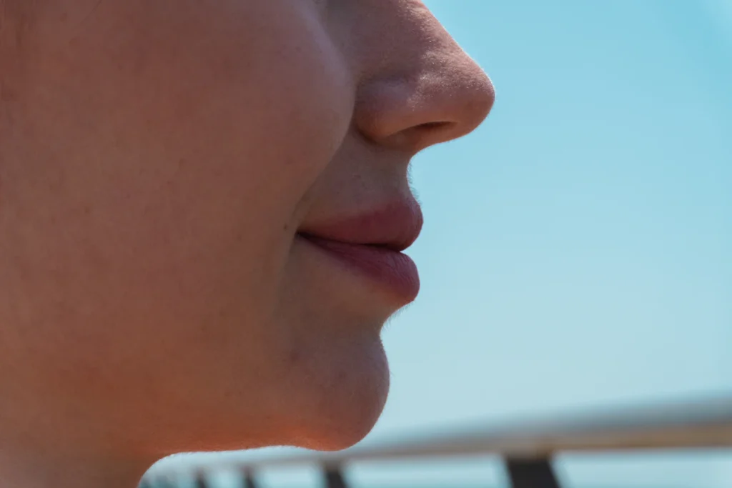 Upper lip in side profile, lip lift in Islamabad
