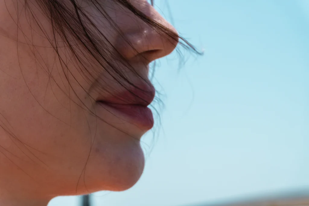 Area under the nose and upper lip, subnasal lip lift