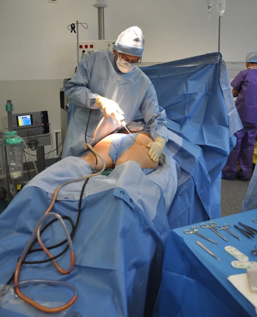 Liposuction being performed in the operating theatre