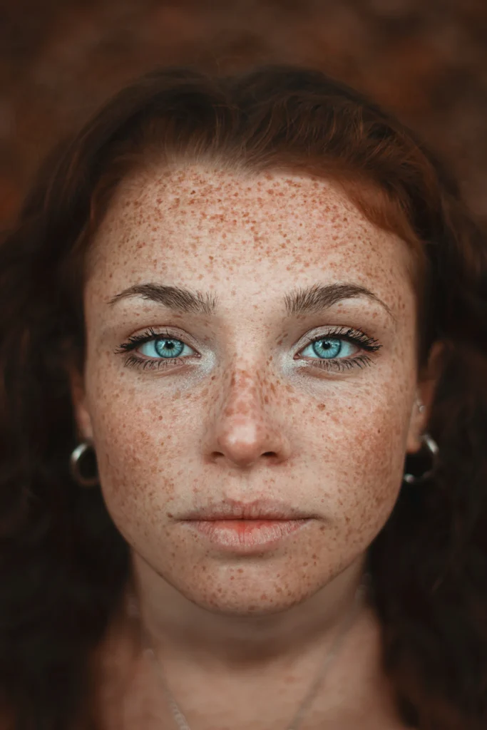 Facial pigmentation across the cheeks