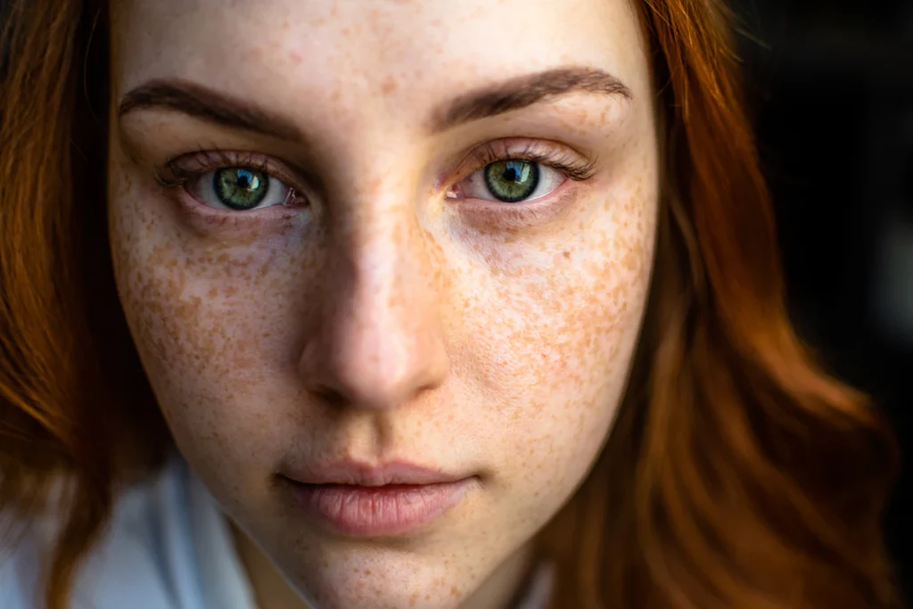 Pigmented facial skin, melasma treatment in Islamabad