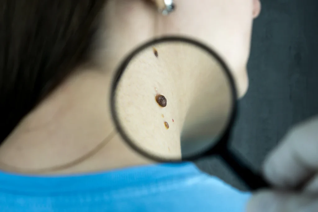 Mole examined with a magnifier, mole removal in Islamabad