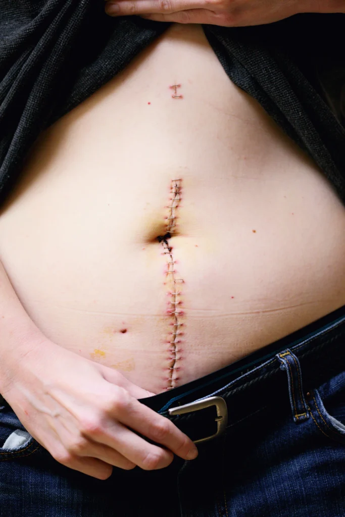 Healed scar on the abdomen, scar revision in Islamabad