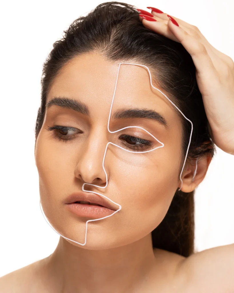 Facial lifting lines for a thread lift